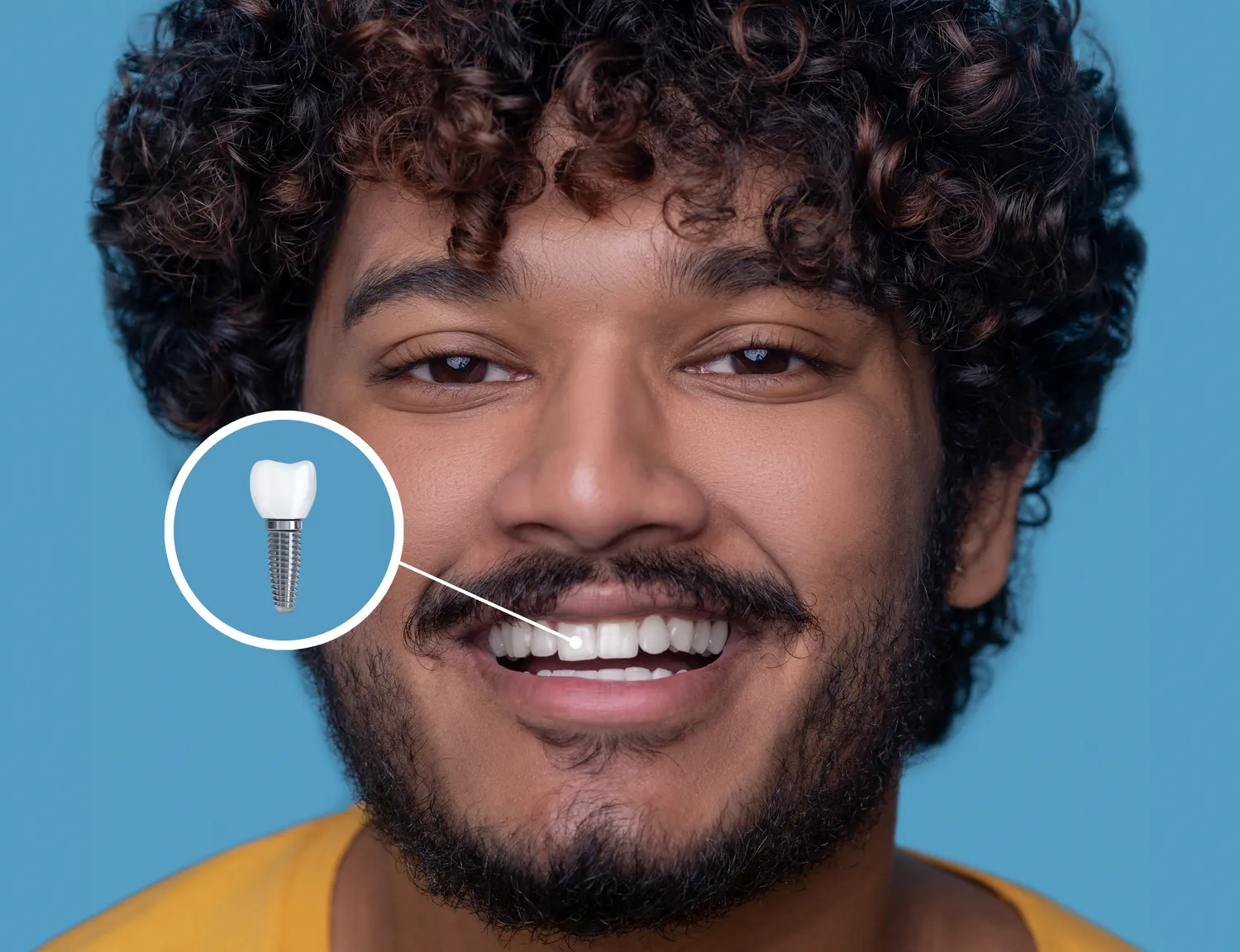 Implantes Dentários 1