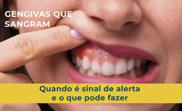 Gengivas que sangram