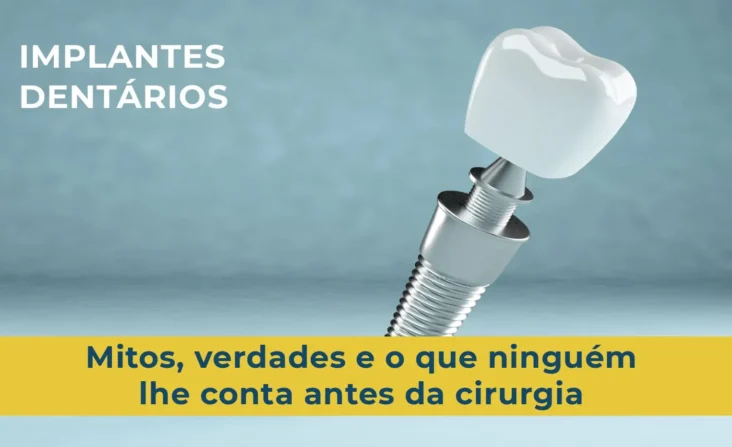 Implantes Dentários o que deve saber
