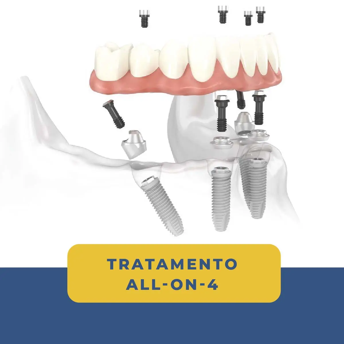 Clínica Bessa 5 Implantes All-On-Four Clinica Bessa
