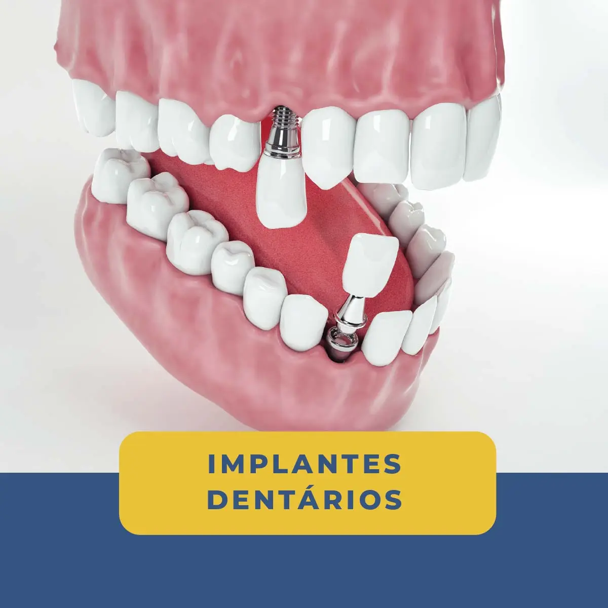 Clínica Bessa 3 Implantes Dentarios na Clinica Bessa