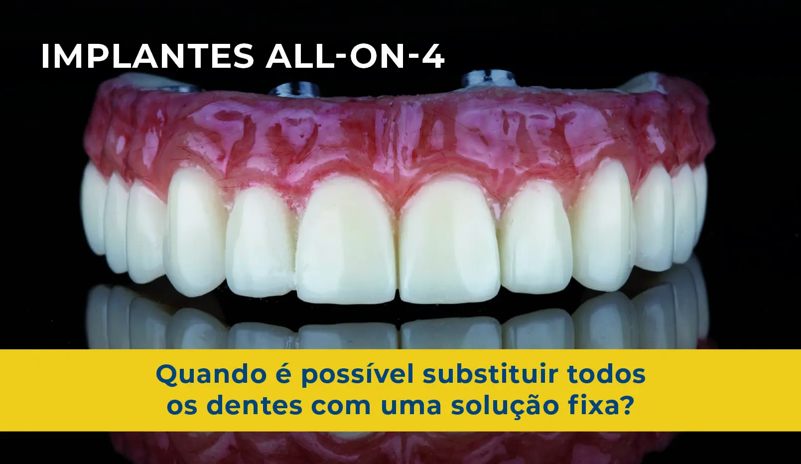 Implantes All-On-Four