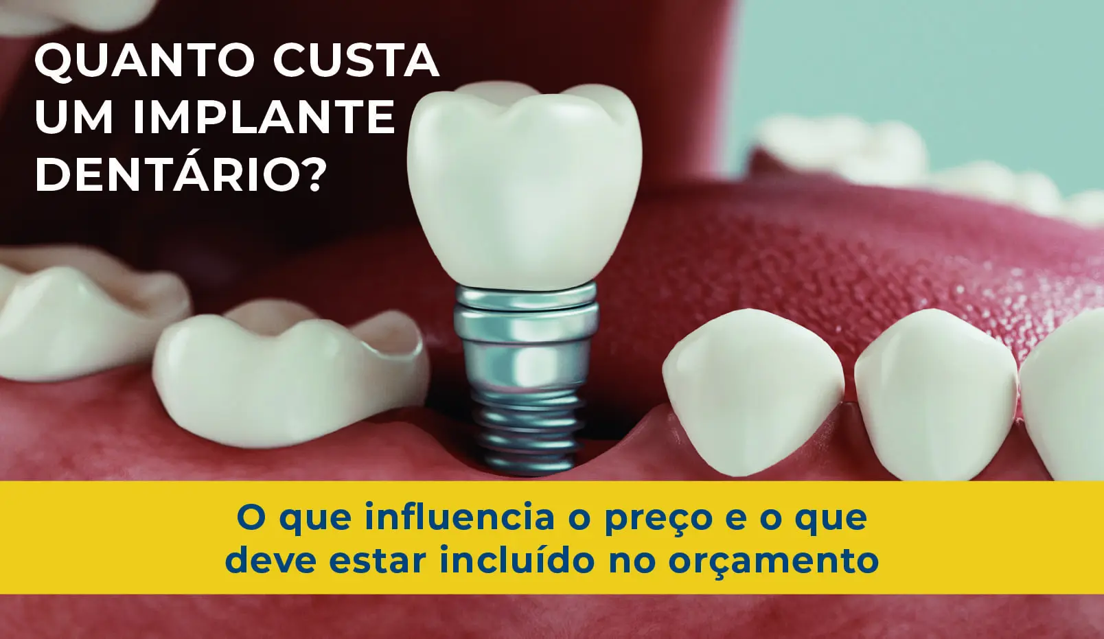 Quanto custa um implante dentario